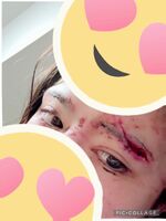 【画像あり】AV女優 辻井ほのかさん、大事故起こして痛々しい姿に 「鼻骨折（2回目）、外頭部骨折、瞼上15針、当分お仕事できないや」